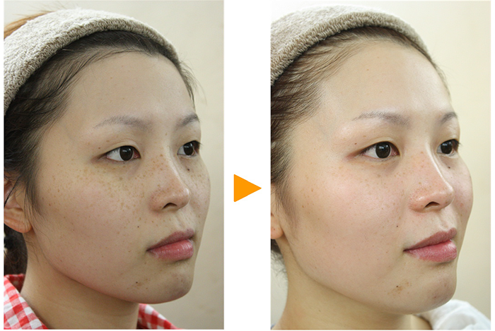 PHÁT HIỆN SỚM 4 DẤU HIỆU THÂM NÁM SAU ĐỂ PHỤC HỒI LÀN DA NHANH HƠN