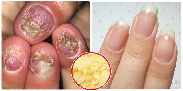 Nấm móng vừa XẤU vừa ĐAU nhưng giờ đã có cách chữa NHANH CHÓNG, HIỆU QUẢ lại RẺ TIỀN