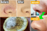 3 Cách khiến mụn đầu đen tự động chui ra không cần nặn đau đớn