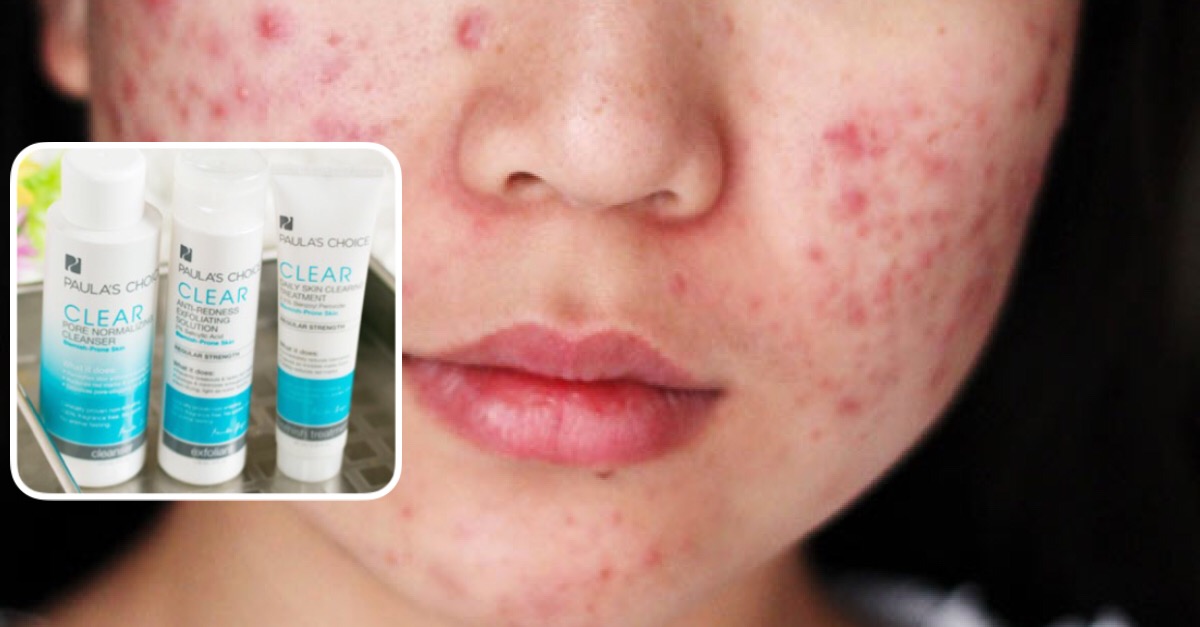 Bật mí 4 thương hiệu mỹ phẩm nổi tiếng dàng cho da dầu và mụn