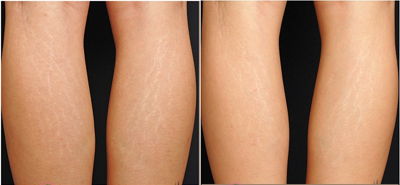 Mẹo hay trị rạn chân ngay tại nhà