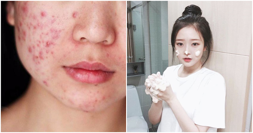 Dẹp tan nỗi sợ mụn trứng cá vào mùa hè vì đã có cách ngừa mụn cực nhạy này