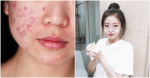 Dẹp tan nỗi sợ mụn trứng cá vào mùa hè vì đã có cách ngừa mụn cực nhạy này