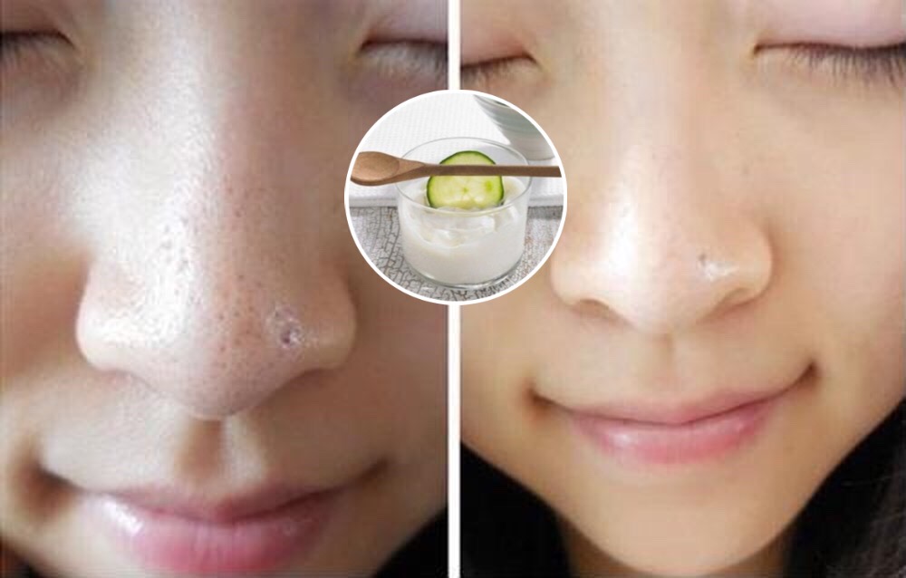 MỤN ĐẦU ĐEN, MỤN CÁM SẼ TỰ “PHỤT RA" MÀ KHÔNG CẦN NẶN ĐAU ĐỚN CHỈ VỚI CÁCH ĐƠN GIẢN NÀY