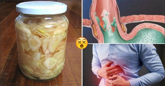“Chấm dứt” bệnh TRÀO NGƯỢC DẠ DÀY hiệu quả sau 3 ngày chỉ với công thức ĐƠN GIẢN DỄ LÀM này!
