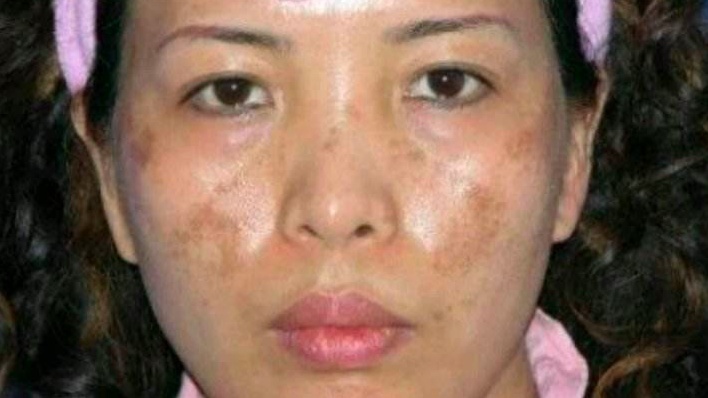 NÁM DA MẶT VÀ CÁCH ĐIỀU TRỊ HIỆU QUẢ