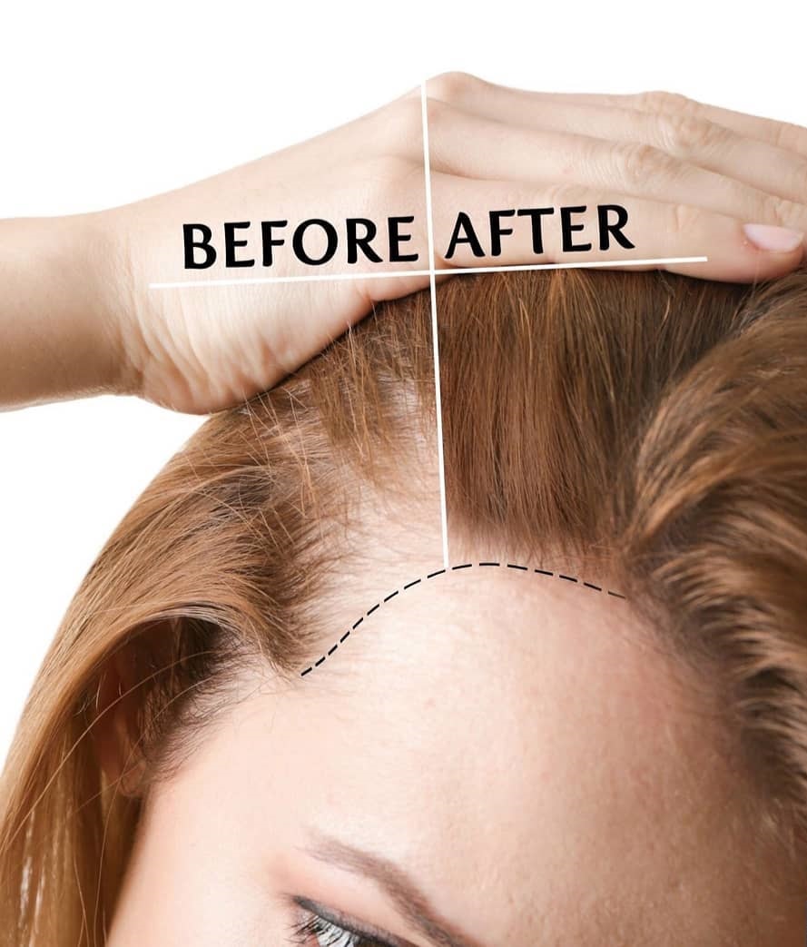 DẤU HIỆU RỤNG TÓC CHO BIẾT ĐÃ ĐẾN LÚC BẠN PHẢI ĐI CHỮA TRỊ