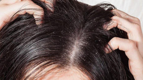 Gàu trắng đầy đầu, ngứa ngáy khó chịu sẽ hết ngay sau khi gội đầu với hỗn hợp tự làm này