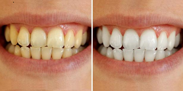 Ngậm hỗn hợp này 5 phút, cao răng tự bong ra thành từng mảng, chấm dứt hôi miệng tức thì, không phải đi nha sĩ