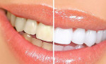 Mẹo xử lý răng ố vàng nhanh chóng và hiệu quả ngay tại nhà