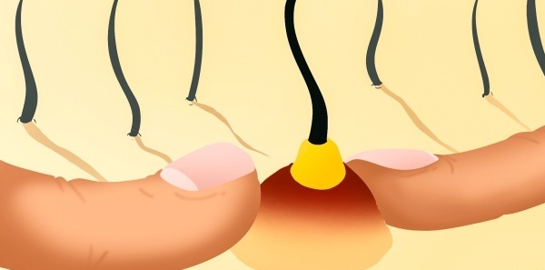 7 ngộ nhận sai lầm về mụn 90&permil; người vẫn đang lầm tưởng, bonus: Chỉ nha khoa có thể đánh bay mụn đầu đen