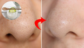 Mụn đầu đen, mụn cám sẽ tự “chui ra” mà không cần nặn đau đớn chỉ với cách làm đơn giản này