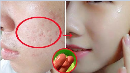 Lấp đầy vết sẹo rỗ chỉ bằng rau má và viên E giá chưa đến 20 nghìn