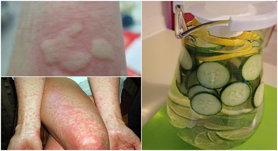 Mẩn ngứa, dị ứng khắp người – CHỈ CẦN uống 1 ly nước này là hết ngay