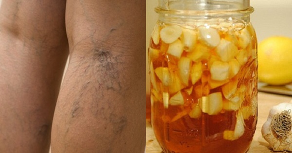 Tỏi + nước cam chữa bệnh suy giãn tĩnh mạch, chân hết thâm bầm, tê cứng