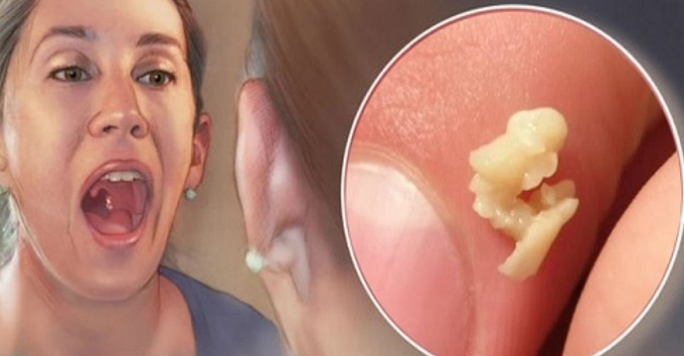 Miệng hôi thối kinh khủng dù bạn rất chăm chỉ đánh răng, đây là nguyên nhân