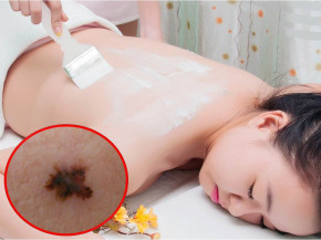 Bác sĩ da liễu cảnh báo: Tắm trắng làm tăng nguy cơ ung thư da