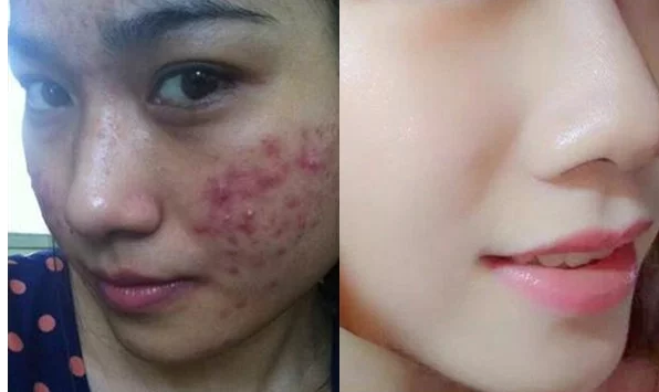 Da đầy mụn, bã nhờn và vết thâm, cô gái học theo cách trên mạng ngâm mặt trong nước có ga 30s và cái kết cực bất ngờ