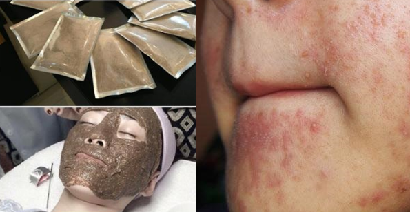 Sử dụng mặt nạ thuốc bắc giá rẻ và cái kết đắng