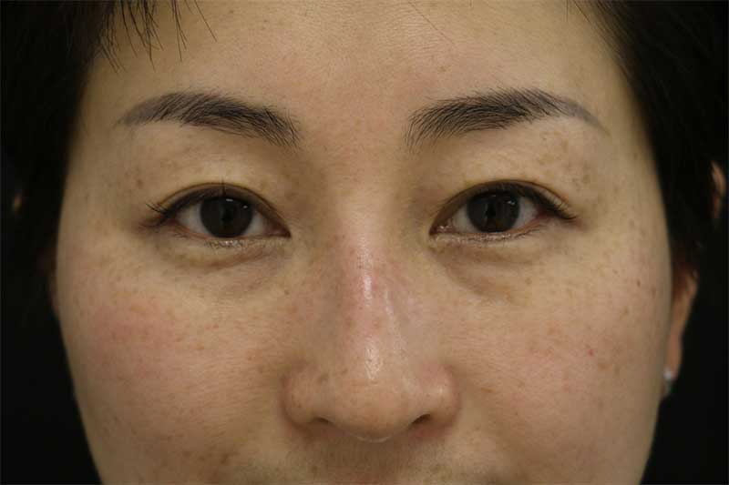 ĐÂU LÀ PHƯƠNG PHÁP ĐIỀU TRỊ NÁM HIỆU QUẢ NHẤT HIỆN NAY?