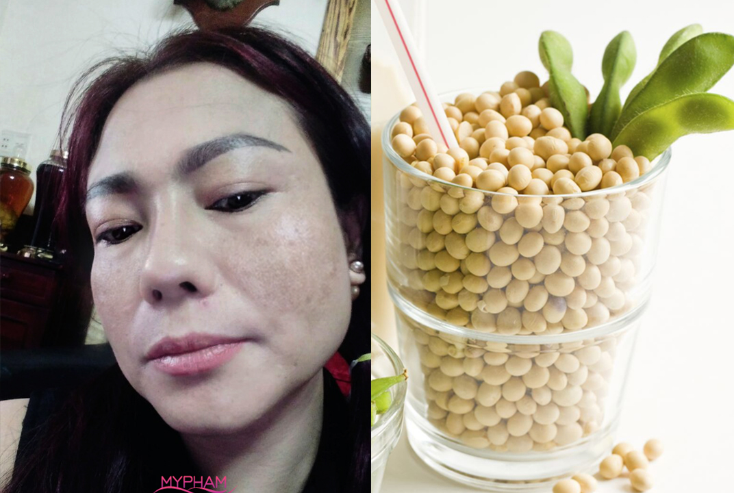 4 NGUYÊN TẮC ĐIỀU TRỊ NÁM DA Ở TUỔI 40