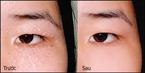 Mụn thịt quanh mắt nhiều đến đâu cũng phải tự khắc biến mất với cách đơn giản này
