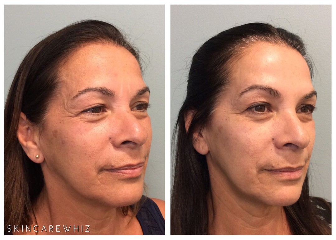 4 cách xóa nếp nhăn trên da hiệu quả nhất hiện nay