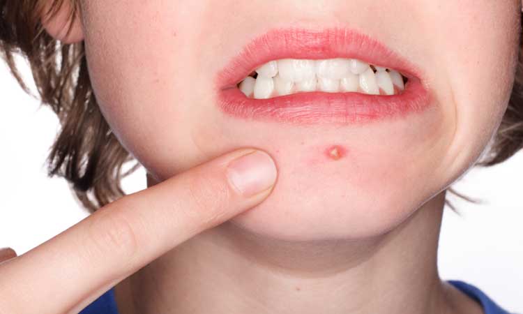 Cách Trị Mụn Bọc Hiệu Qủa Và Nhanh Chóng