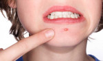 Cách Trị Mụn Bọc Hiệu Qủa Và Nhanh Chóng