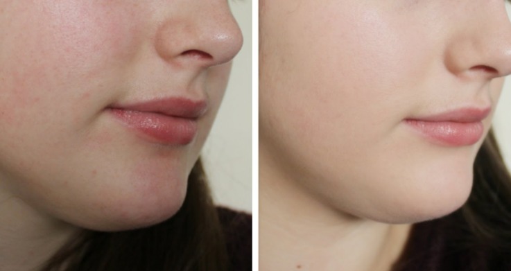 Cách Phục Hồi Da Mỏng Do Dùng Kem Trộn