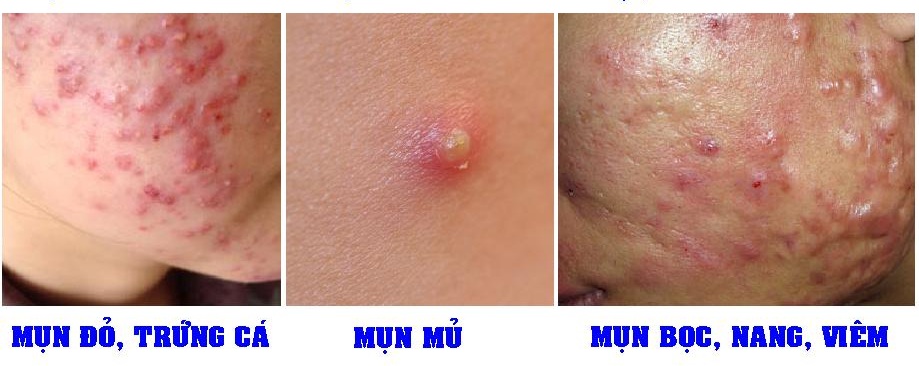 Phân Biệt Và Điều Trị Các Loại Mụn Viêm, Mụn Bọc, Mụn Đỏ