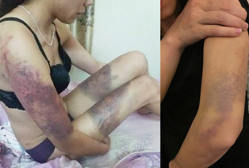 Bị chồng đánh đập tàn bạo không thương tiếc nhưng cô không dám ly hôn