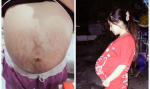 Vết rạn da chằng chịt sau khi sinh 4 con của mẹ trẻ xinh như hotgirl khiến mọi người không khỏi xót xa