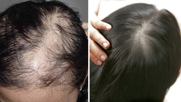 Chà 1 lát tỏi lên tóc, cô gái chữa khỏi chứng tóc rụng, hói đầu lại mọc nhanh 10cm