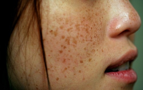 Với Nguyên Liệu Tự Nhiên, Đồi Môi - Đốm Nâu Chỉ Là Chuyện Nhỏ!