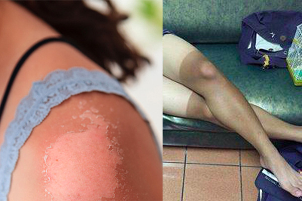 15 cách thần tốc chữa da cháy nắng khi đi biển