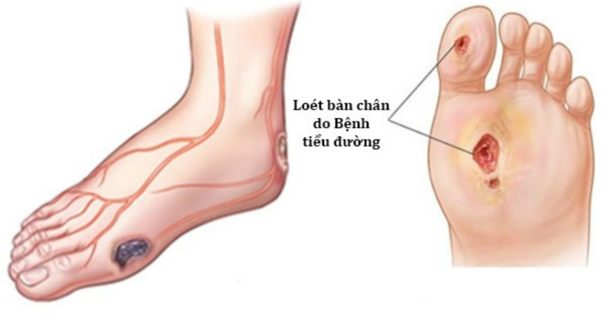 Khoa học đã tìm ra cách chữa DỨT ĐIỂM tiểu đường, dù bệnh 10 năm cũng hết trong vòng 8 tuần