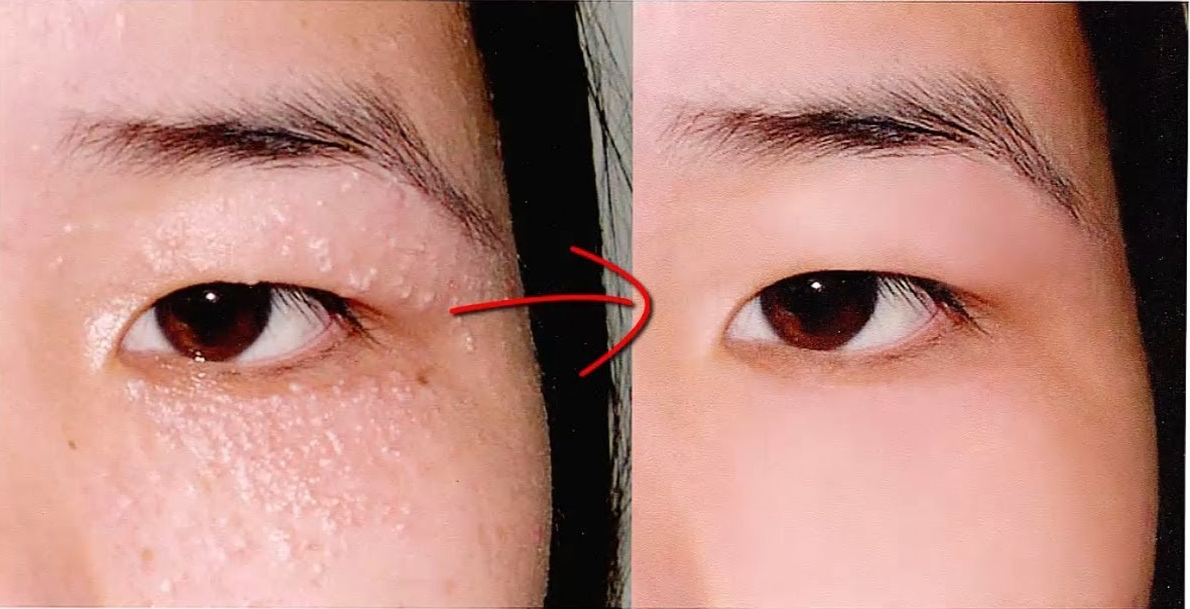 5 Bài thuốc tự nhiên giúp bạn tự điều trị mụn thịt tại nhà dễ dàng