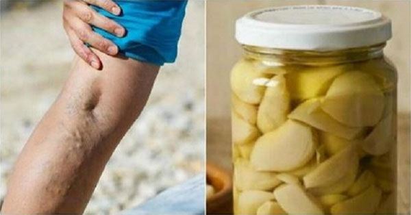 Dùng tỏi và nước cam, chân tay bị giãn tĩnh mạch thâm xanh, nổi cộm sẽ lặn sạch sẽ