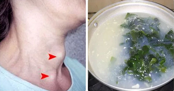 Bài thuốc đặc trị bướu cổ, bướu to bằng trái chanh cũng hết