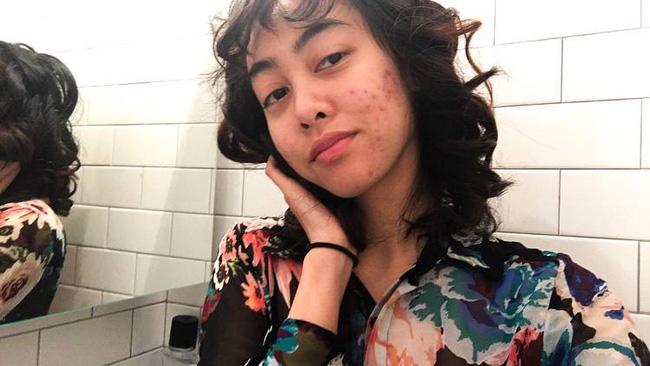 Trào lưu khỏe ảnh mặt xinh, da đẹp đã qua - Xu hướng HOT năm 1018 là đăng ảnh mặt mụn nhé!