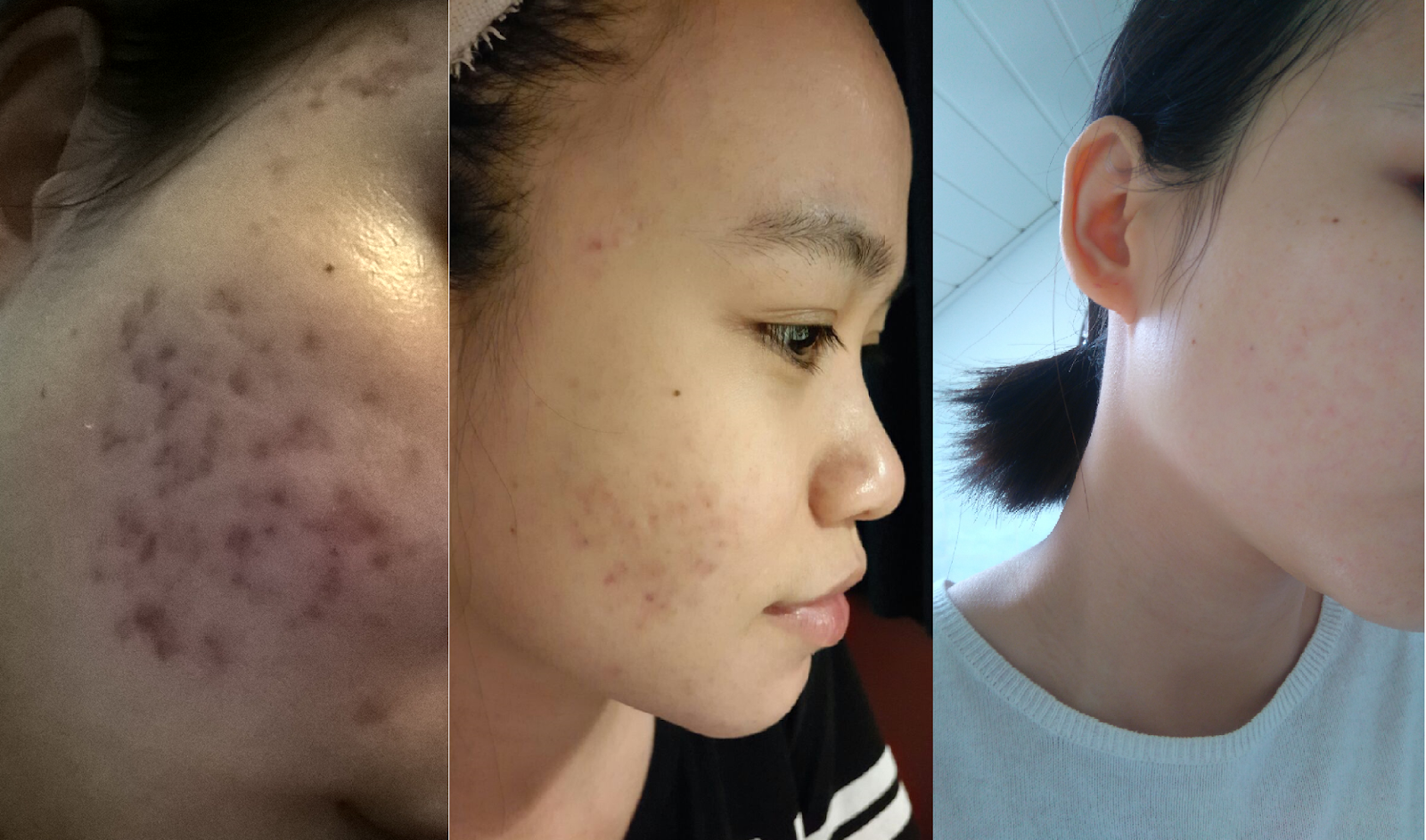 7 Lỗi trang điểm cơ bản là “bạn thân” của lũ mụn mà bạn cần tránh xa