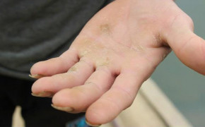 4 Mẹo chữa chai tay hiệu quả mà đơn giản tại nhà cho bạn đôi tay mềm mịn như ý