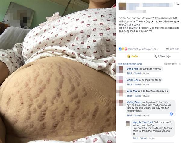 Bụng mỡ cả rổ, da rạn tựa ngựa vằn, mẹ xót xa: “Có nỗi đau nào hằn lên như thế!”