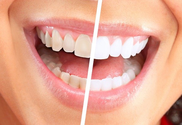 Răng Trắng Tinh Chỉ Nhờ Nước Vo Gạo! Bạn Tin Không?