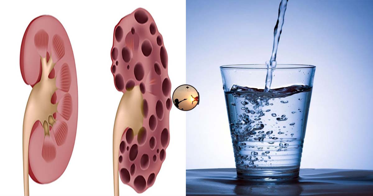Cách kiểm tra xem có bị bệnh thận hay không: Chỉ vài 1 phút và 1 ly nước sạch