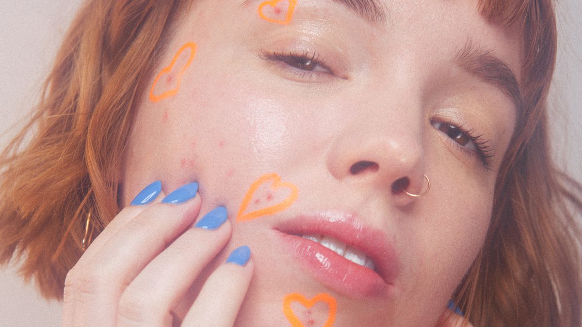 Bản đồ mụn bật mí sức khỏe của bạn và cách chữa trị!!!