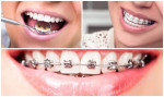 Để Niềng răng đạt hiệu quả nhất không thể vỏ qua những lưu ý quan trọng này