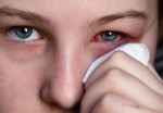 Tuyệt chiêu trị đau mắt đỏ hữu hiệu bằng khoai tây, mật ong