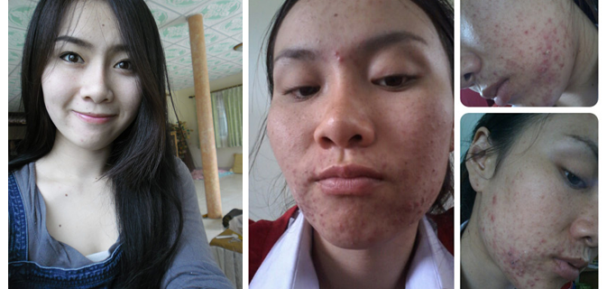 Cô gái Thái tan hoang mặt mày vì bôi kem trắng da rởm